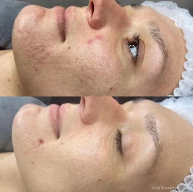 Skin Therapy Microneedling Bordeaux, Bordeaux - Photo 2