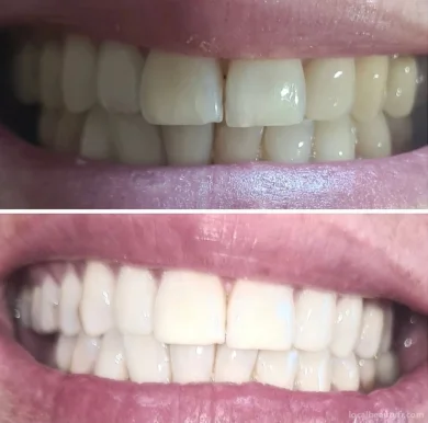 RemaBeauty - Extension de Cil - Injection hyaluronique (HaluronPen) - Blanchiment Dentaire, Lyon - Photo 2
